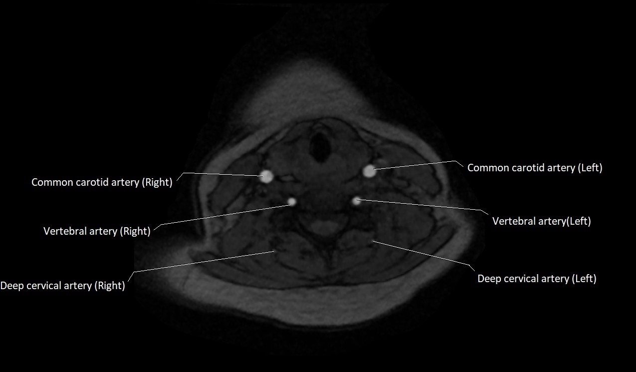 Carotid artery anatomy axial 3T image 42.jpg